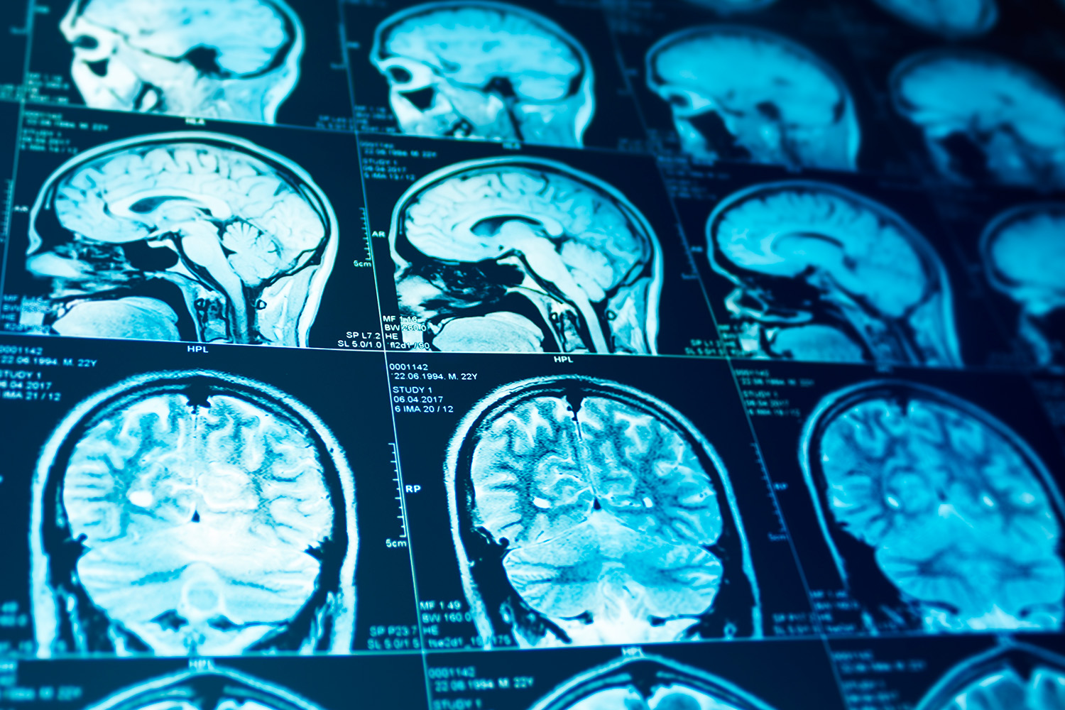 augmented reality in neurosurgery